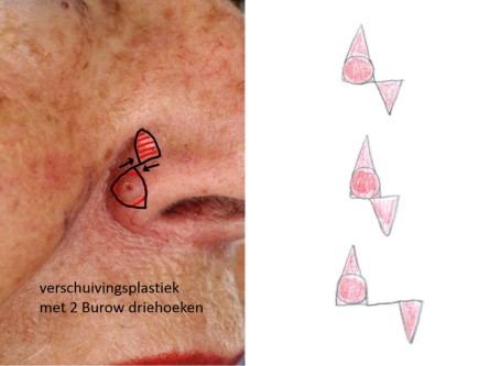 Burow advancement flap