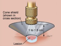Basosquameus basaalcelcarcinoom