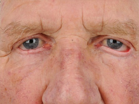 Curettage keratoacanthoom