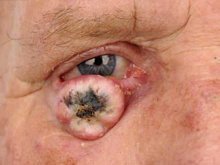 Curettage keratoacanthoom