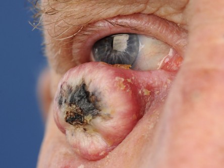 Curettage keratoacanthoom