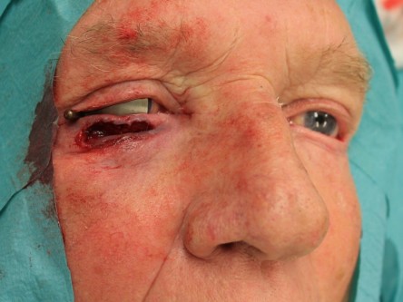 Curettage keratoacanthoom