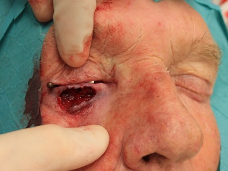 Curettage keratoacanthoom