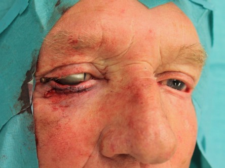 Curettage keratoacanthoom