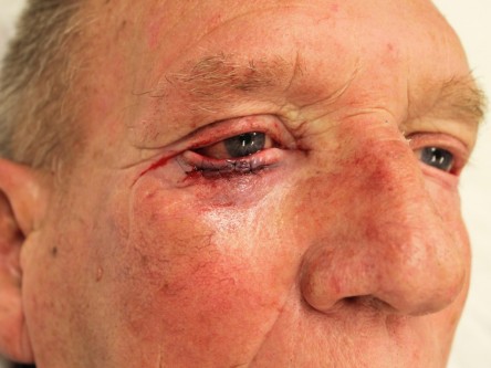 Curettage keratoacanthoom