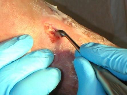 Debridement van ulcera