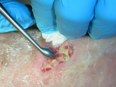 Debridement van ulcera