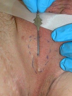 Deroofing bij hidradenitis suppurativa