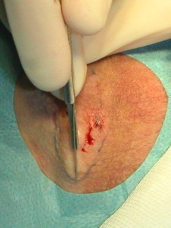 Deroofing bij hidradenitis suppurativa