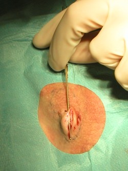 Deroofing bij hidradenitis suppurativa