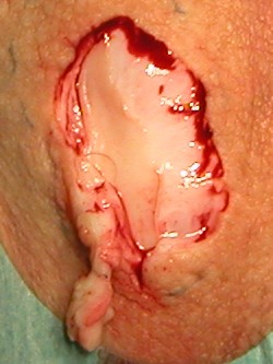 Deroofing bij hidradenitis suppurativa