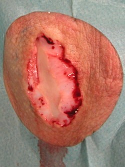 Deroofing bij hidradenitis suppurativa