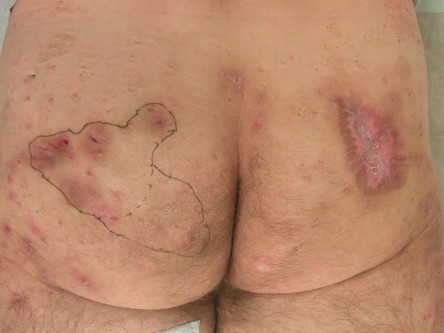 Deroofing bij HS, diep