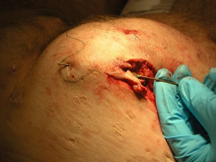 Deroofing bij HS, diep