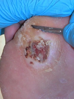 Excisie diabetisch ulcus