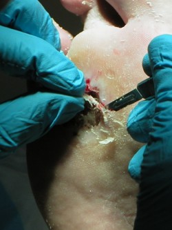Excisie diabetisch ulcus