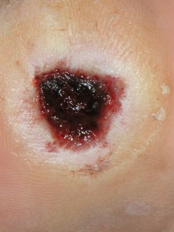 Excisie diabetisch ulcus