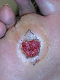 Excisie diabetisch ulcus