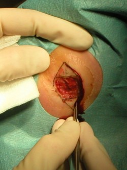 Excisie diabetisch ulcus