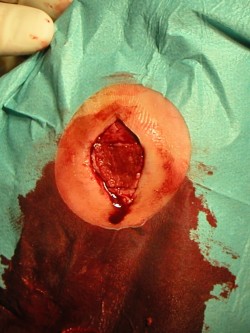 Excisie diabetisch ulcus