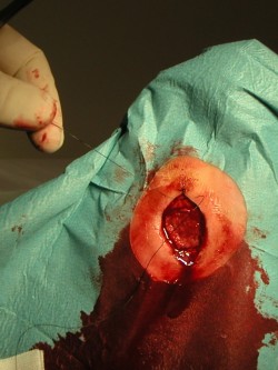 Excisie diabetisch ulcus