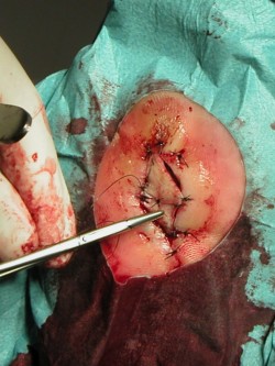 Excisie diabetisch ulcus