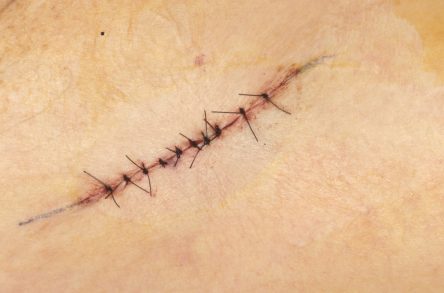 Punchgrafts transplanteren vanuit ovaal