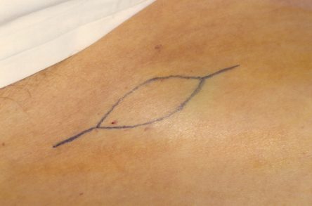 Punchgrafts transplanteren vanuit ovaal