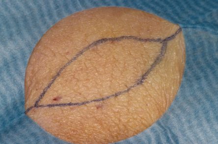 Punchgrafts transplanteren vanuit ovaal