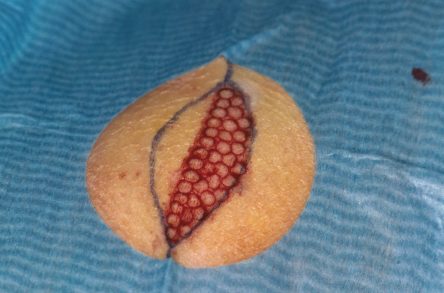 Punchgrafts transplanteren vanuit ovaal