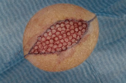 Punchgrafts transplanteren vanuit ovaal