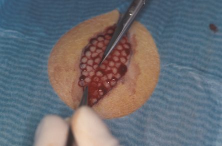 Punchgrafts transplanteren vanuit ovaal