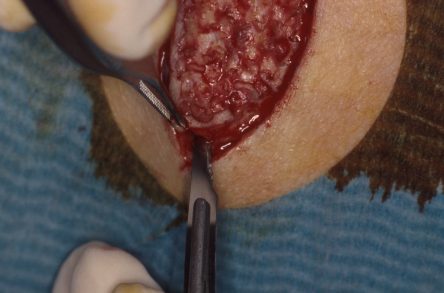 Punchgrafts transplanteren vanuit ovaal