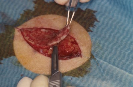 Punchgrafts transplanteren vanuit ovaal