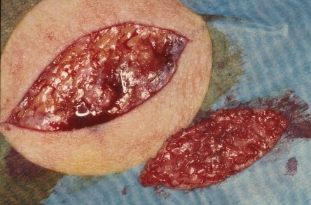 Punchgrafts transplanteren vanuit ovaal