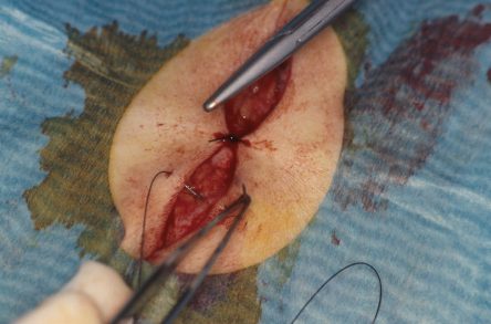 Punchgrafts transplanteren vanuit ovaal