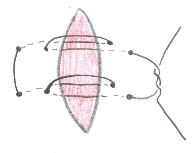 Double pulley stitch