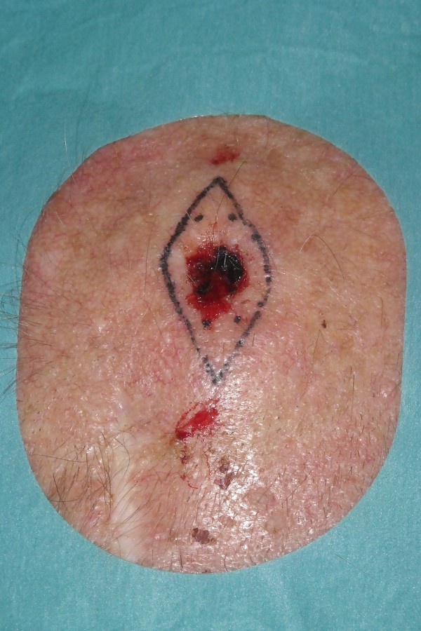 Dubbele katrolhechting