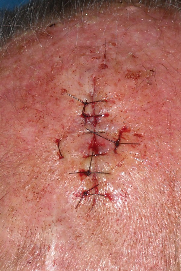 Dubbele katrolhechting