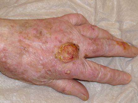 Elektrocoagulatie plaveiselcelcarcinoom