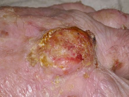 Elektrocoagulatie plaveiselcelcarcinoom