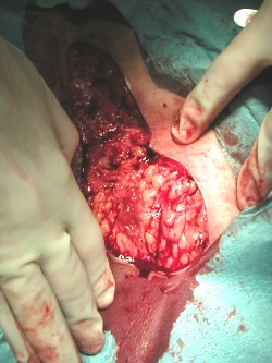 Excisie hidradenitis suppurativa