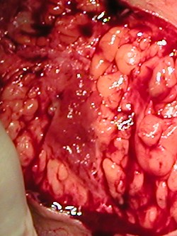 Excisie hidradenitis suppurativa