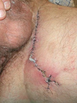 Excisie hidradenitis suppurativa