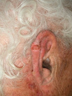 Plaveiselcelcarcinomen oorrand