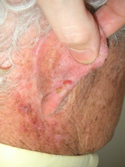 Plaveiselcelcarcinomen oorrand