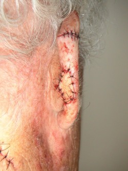 Plaveiselcelcarcinomen oorrand