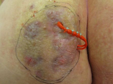 Excisie fistelcomplex op de bil bij hidradenitis suppurativa