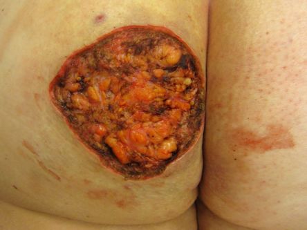 Excisie fistelcomplex op de bil bij hidradenitis suppurativa