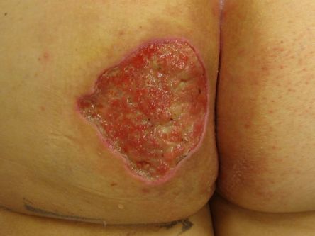Excisie fistelcomplex op de bil bij hidradenitis suppurativa